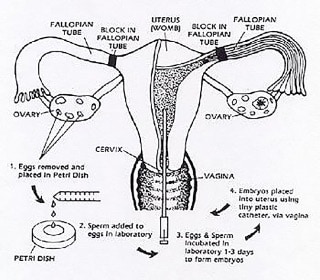 img-in-vitro-fertilization